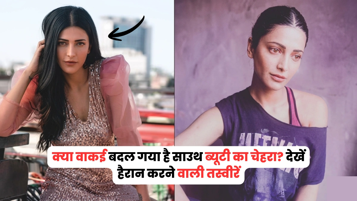 shruti haasan before and after surgery​